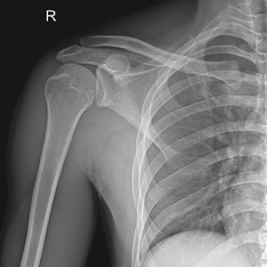 Radiografía de costillas y pulmón